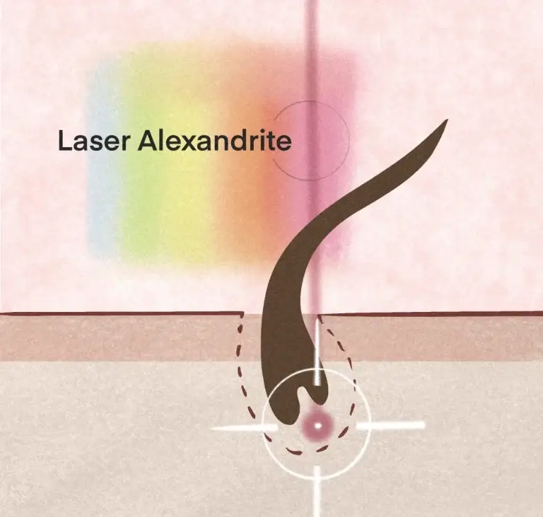 Laser Alexandrite - istoric si mod de functionare