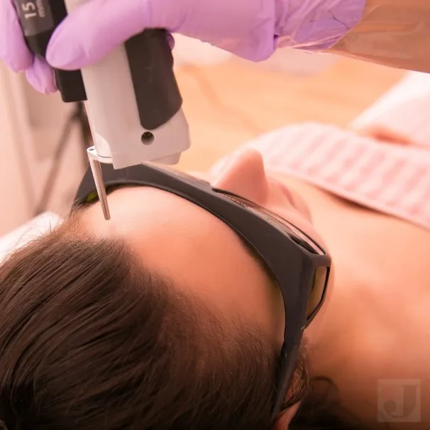 Epilare cu laser Alexandrite fata