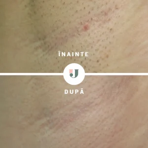Rezultate epilare definitivă axilă dupa sase sedinte de epilare laser