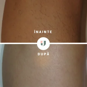 Rezultate picioare dupa 9 sedinte