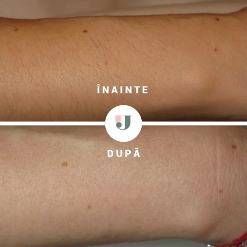 rezultate epilare definitiva cu laser alexandrite pentru brate dupa 8 sedinte