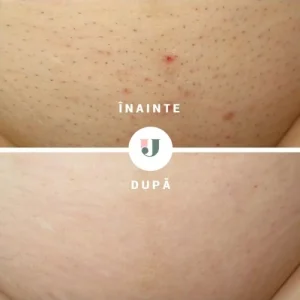 Rezultate epilare definitiva cu laser alexandrite pentru inghinal