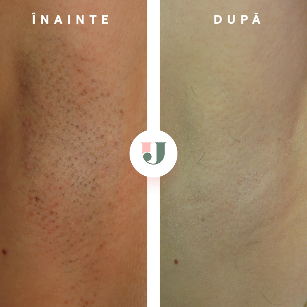 rezultate epilare definitiva cu laser axila dupa 7 sediinte