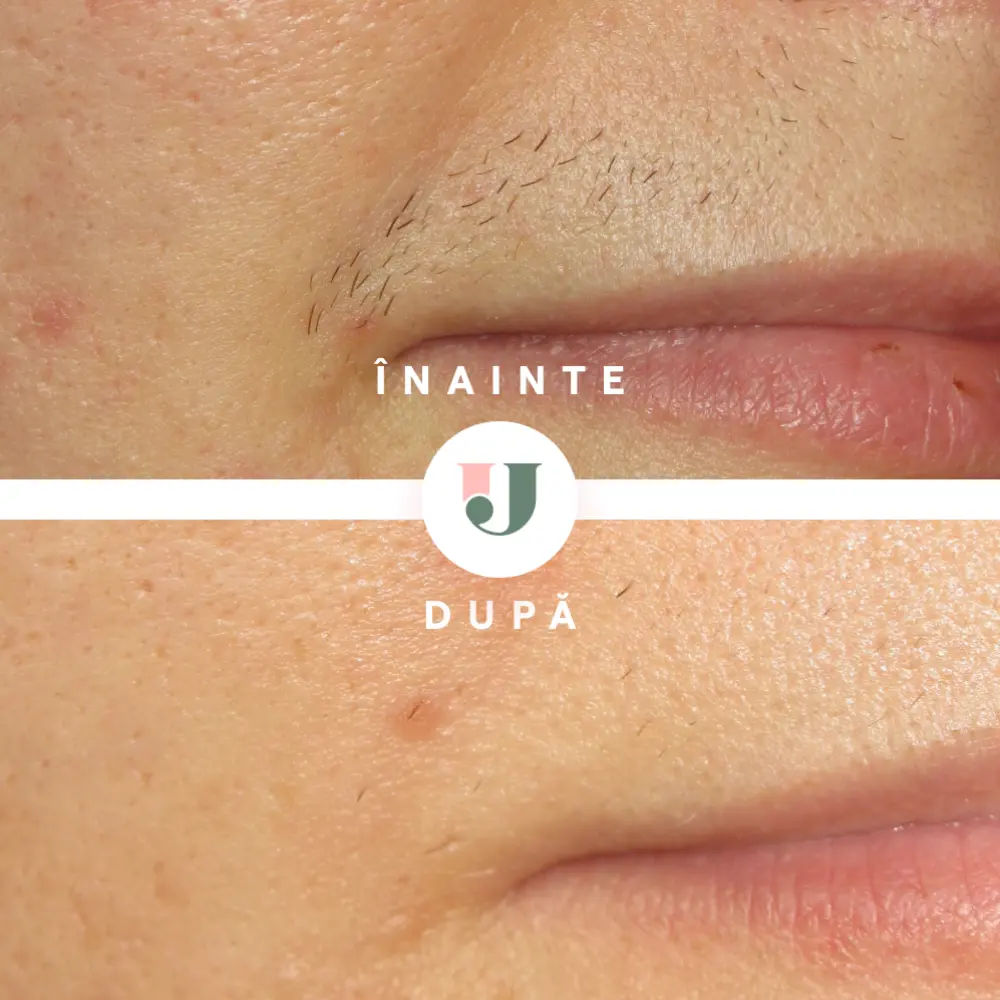 Rezultate epilare mustata cu laser alexandrite dupa 9 sedinte