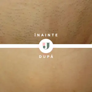 Rezultate epilare definitiva inghinal dupa 7 sedinte