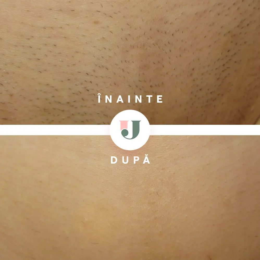 Rezultate epilare definitiva inghinal dupa 7 sedinte